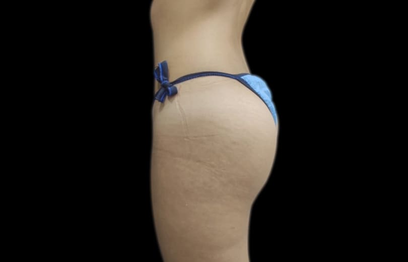 cirugia de gluteos Gluteoplastia ML