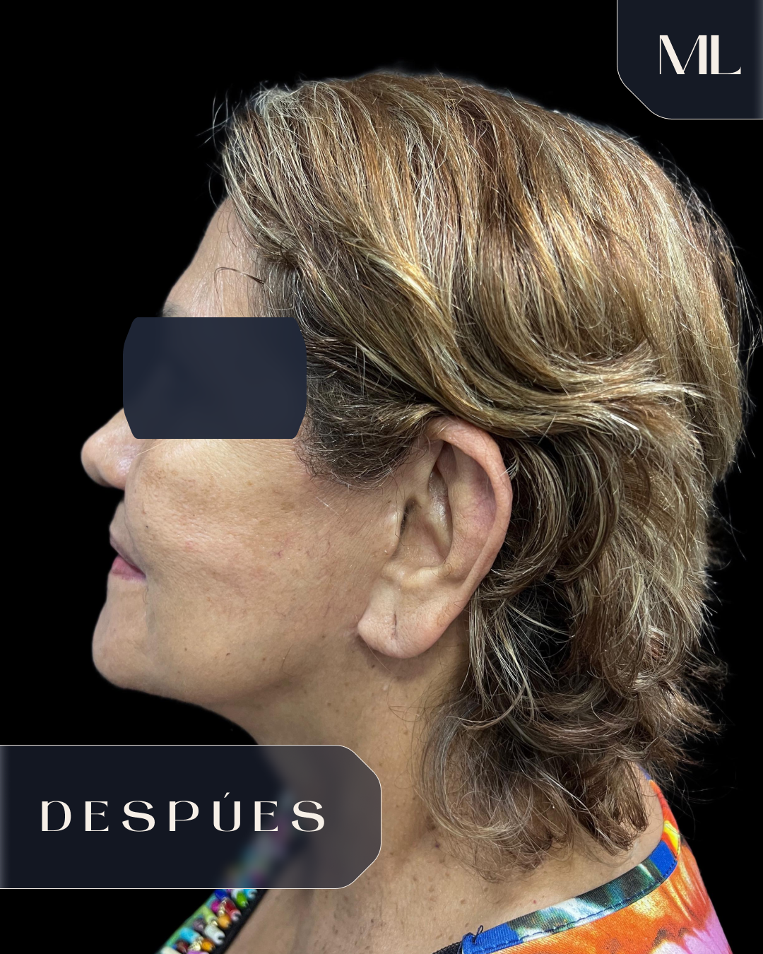 Ritidoplastia después